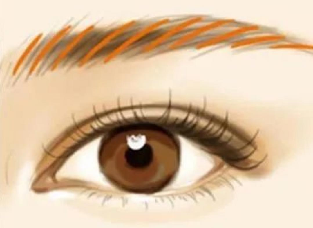 Hinterlässt die Laser-Microblading-Entfernung (Entfernung von Augenbrauen-Tattoos) Narben?