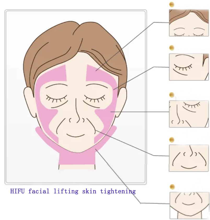 Wie zeichnet man Behandlungsleitungen vor der Behandlung der Gesichtsbehandlung mit der HIFU -Gesichtsbehandlung, um Hautschäden zu vermeiden?